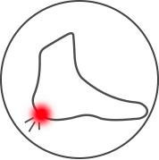 Plantar Fasciitis