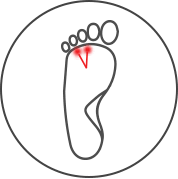 Morton's Neuroma